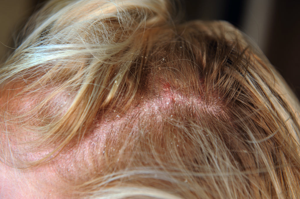Mereltä’s Treatment for Scalp Inflammation