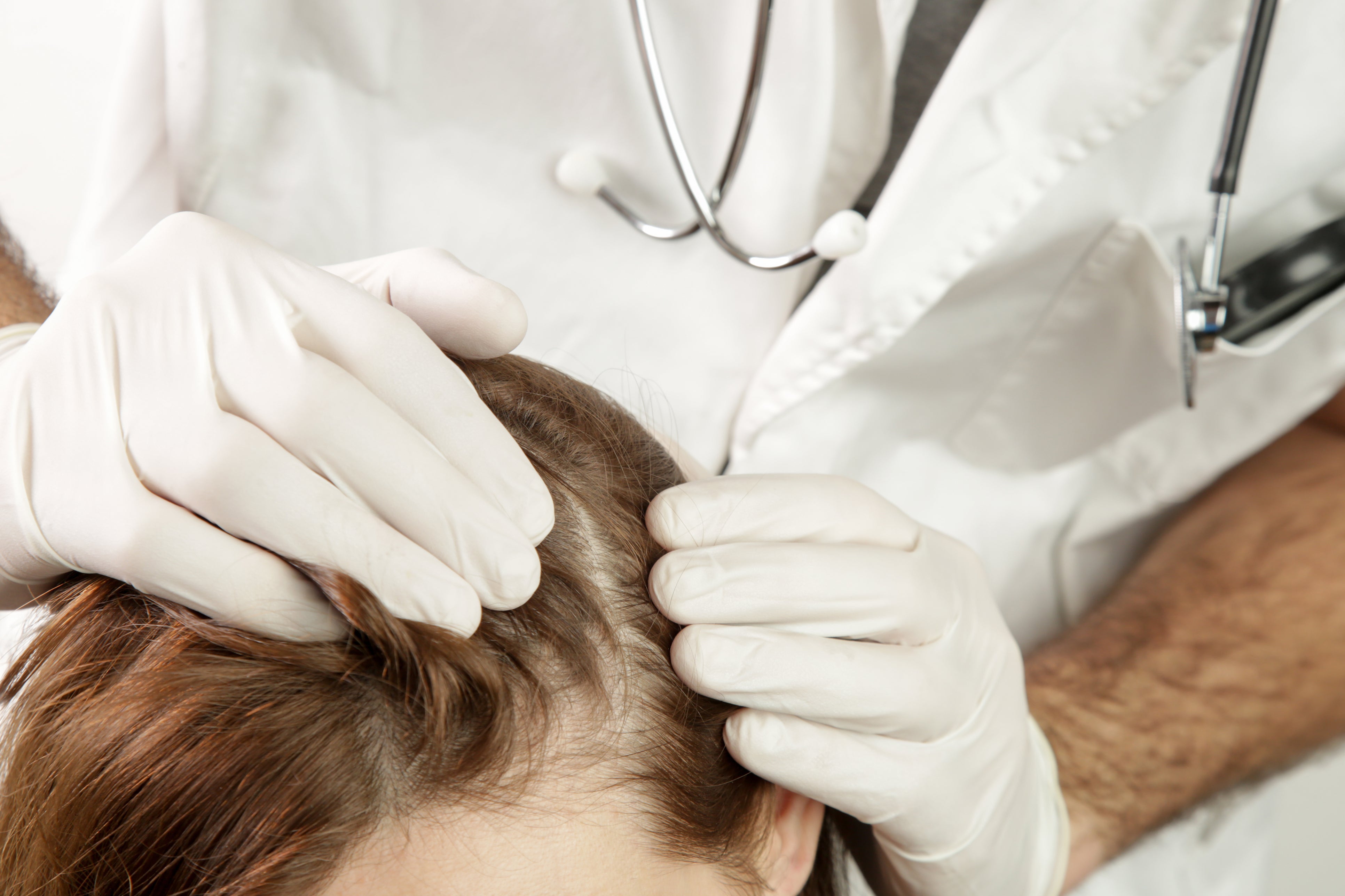 Scalp Psoriasis Inspection | Mereltä's Treatment for Scalp Psoriasis