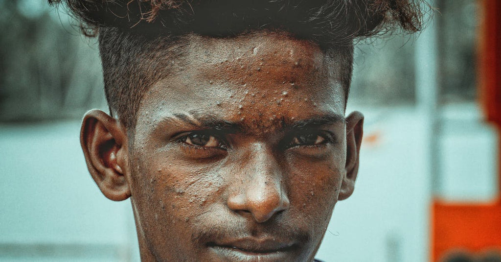 How To Heal Scalp Psoriasis?